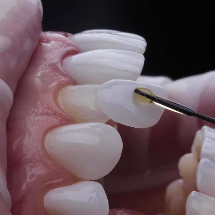 Colocación de una carilla dental de porcelana