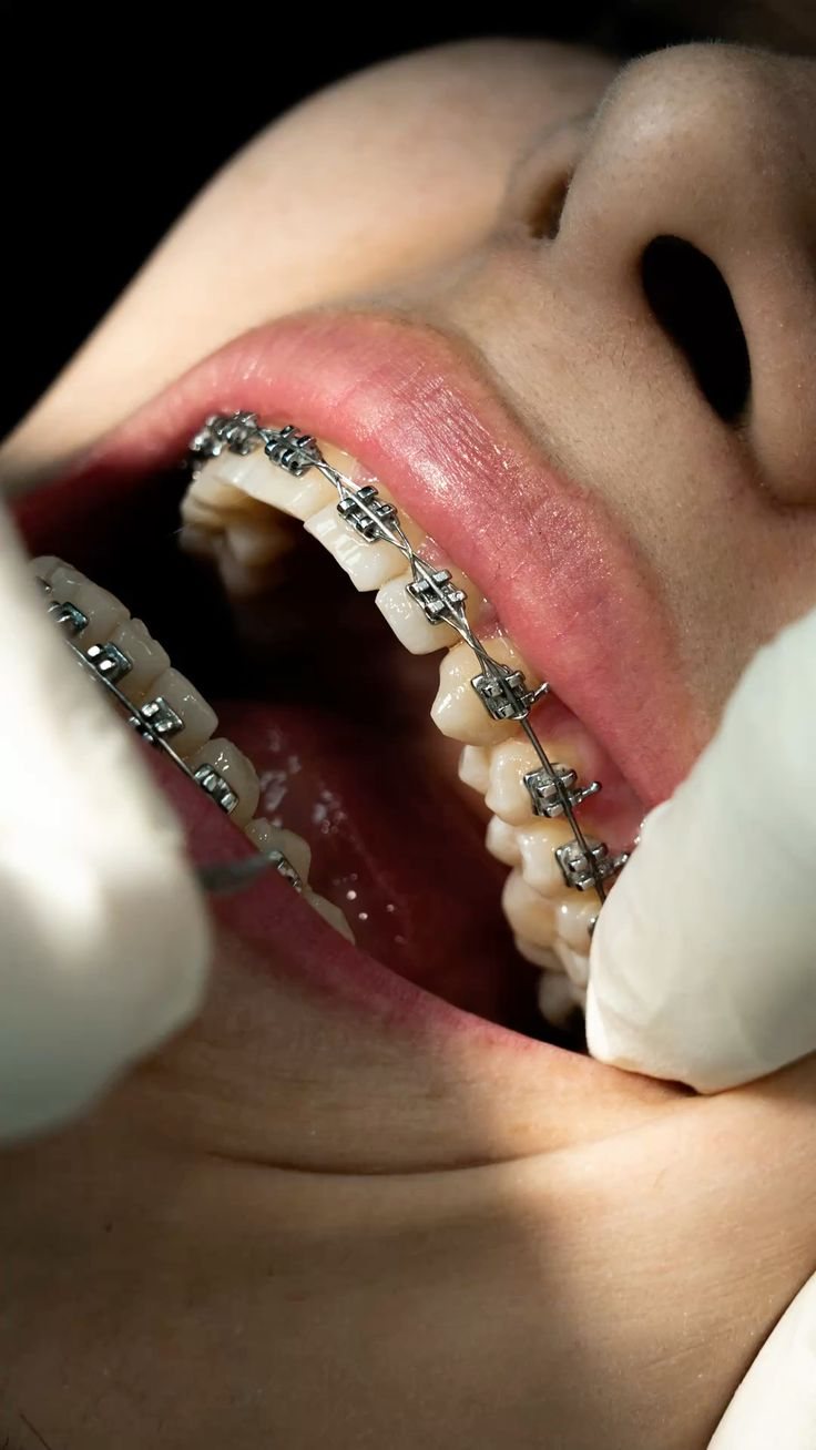 Brackets metálicos colocados durante un tratamiento de ortodoncia